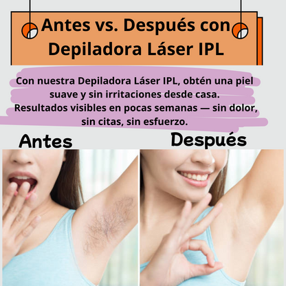 Depiladora de laser IPL